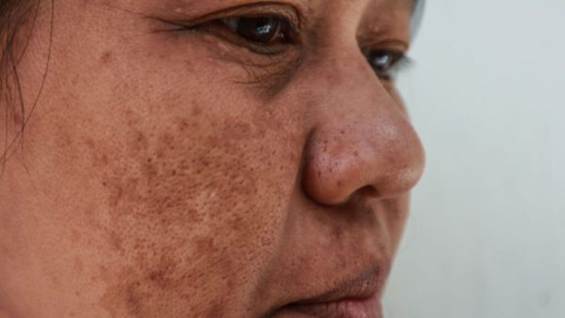 melasma